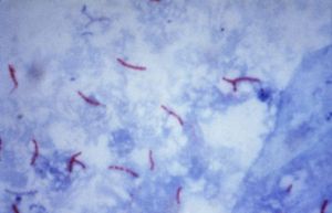 800px-Mycobacterium_tuberculosis_Ziehl-Neelsen_stain_02